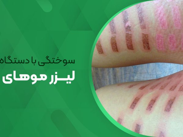 سوختگی با دستگاه های لیزر موهای زائد