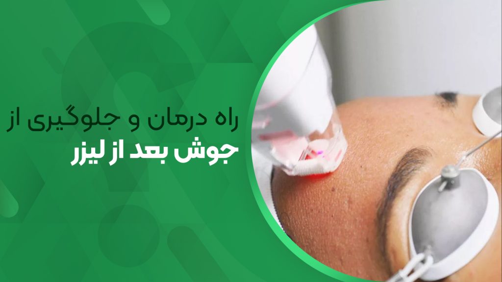 راه درمان و جلوگیری از جوش بعد از لیزر موهای زائد