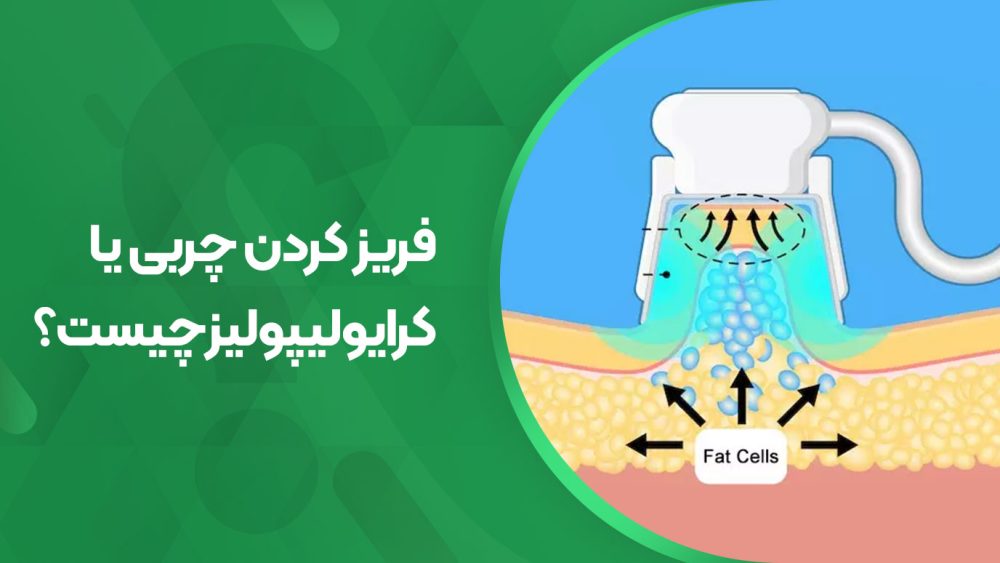 جوابدهی کرایولیپولیز چیست؟
