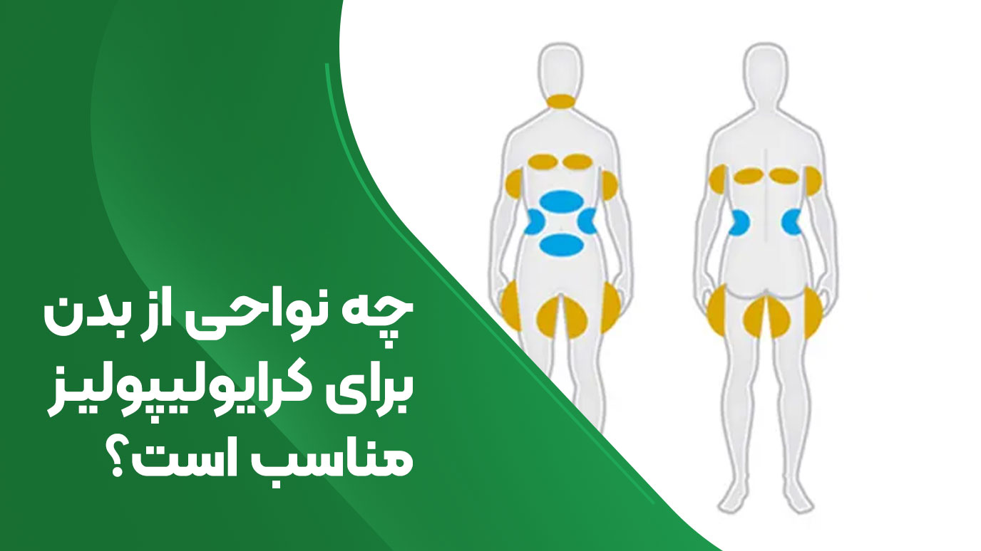 چه نواحی از بدن برای کرایولیپولیز مناسب است؟