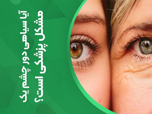 آیا سیاهی دور چشم یک مشکل پزشکی است؟