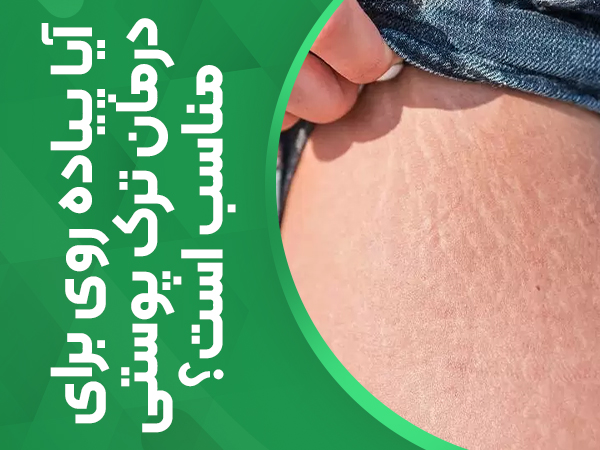آیا پیاده روی برای درمان ترک پوستی مناسب است؟