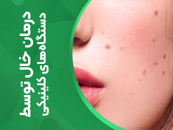 درمان خال توسط دستگاه های کلینیکی