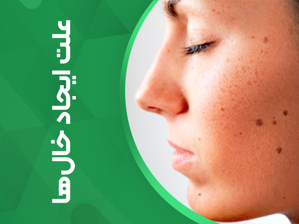 علت ایجاد خال_ها