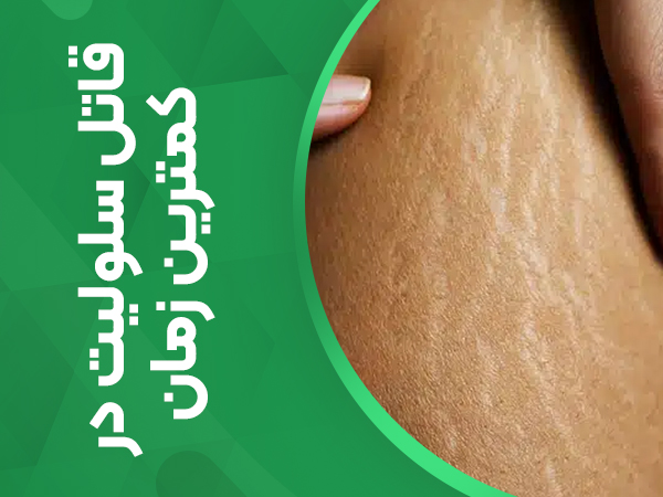 درمان کیلنیکی سلولیت 