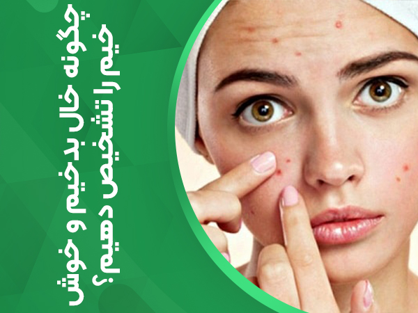 چگونه خال بدخیم و خوش خیم را تشخیص دهیم؟