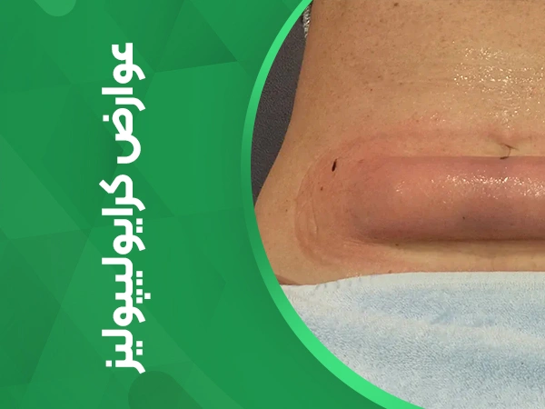 تصویر عوارض کرایولیپولیز