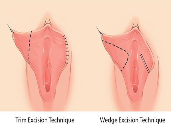 تصویر روش‌های جراحی لابیاپلاستی تریم (Trim) و ودج (Wedge)