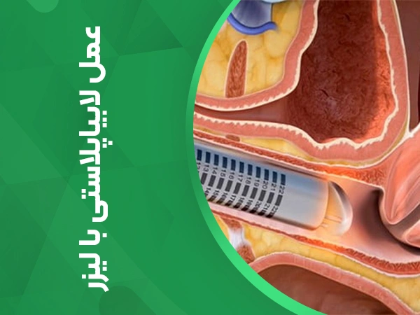 تصویر عمل لابیاپلاستی با لیزر