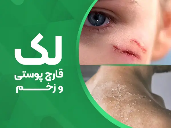 تصویر لک قارچ پوستی و زخم