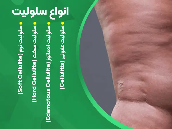 انواع سلولیت