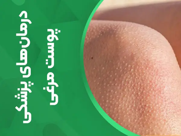 درمان‌های پزشکی پوست مرغی
