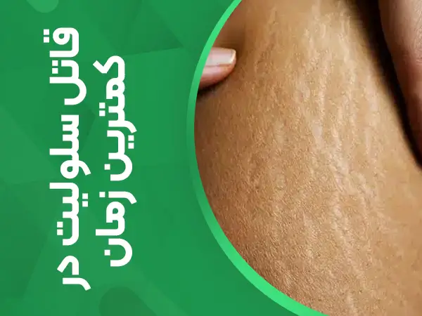 درمان کیلنیکی سلولیت